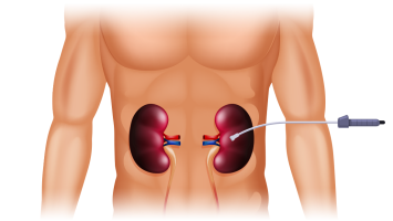 1100x620-cirurgia-laparoscópica