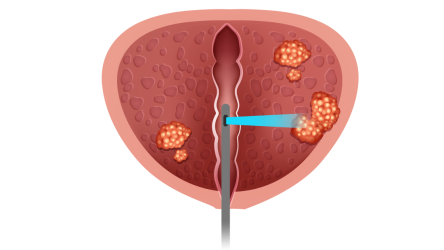 1100x620-cirurgia-robótica